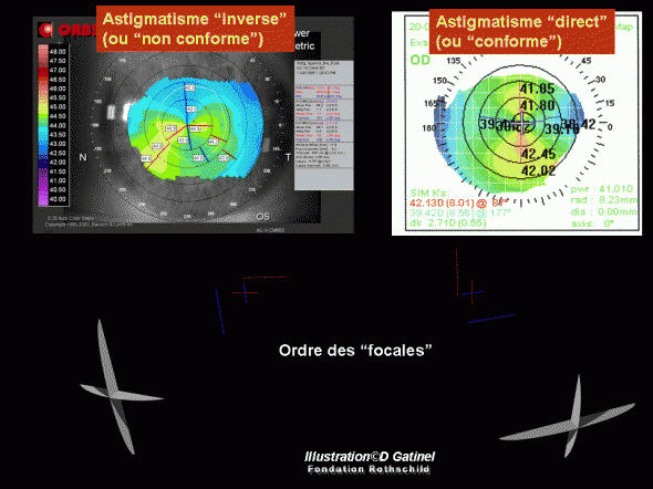 Astigmatisme with-against the rule Astigmatisme with-against the rule