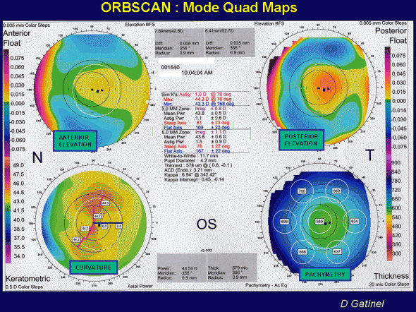 Orbscan Orbscan