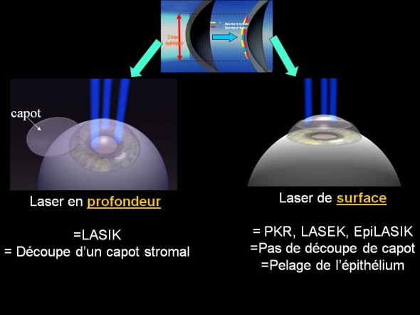 laser ou lasik