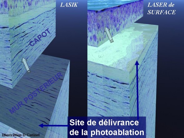 Lasik surface