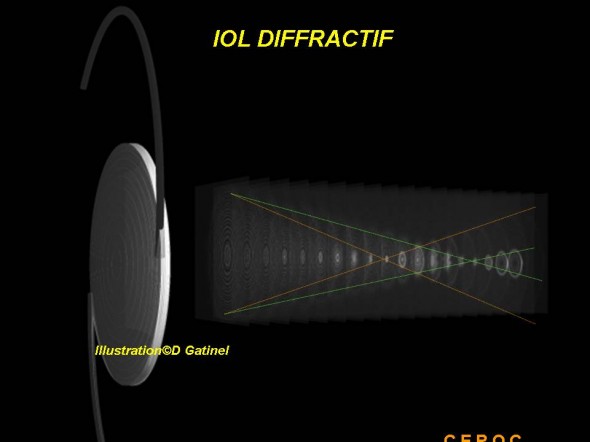 IOL diffractif IOL diffractif
