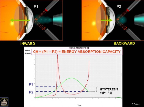 ORA CORNEAL HYSTERESIS