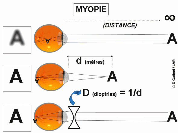 Dioptrie Myopie Dioptrie Myopie