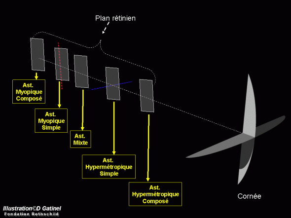Asitgmatisme classification Asitgmatisme classification