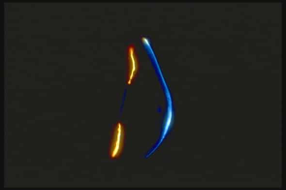 Kératocône