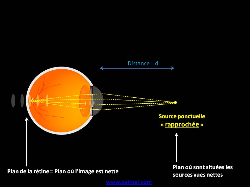 La vision floue du myope Docteur Damien Gatinel