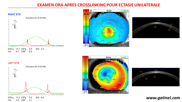 Makgré la réalisation d'un CXL, aucune amélioration de la rigidité cornéenne n'est mesurée, ni du côté de l'ectasie, ni du côté sans ectasie. 