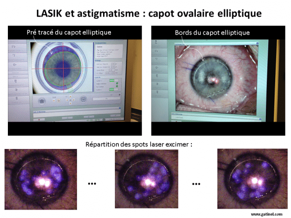 capot ovalaire ou elliptique pour la correction en LASIK de l'astigmatisme