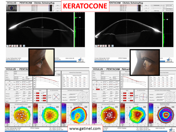 kératocone évolué asymétrique