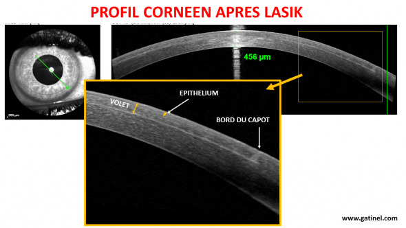 LASIK profil cornéen OCT haute résolution