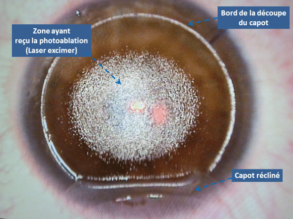 Après délivrance de la photoablation, l'interface est nettoyée d'éventuels débris, et le capot est reposé sur le stroma. 