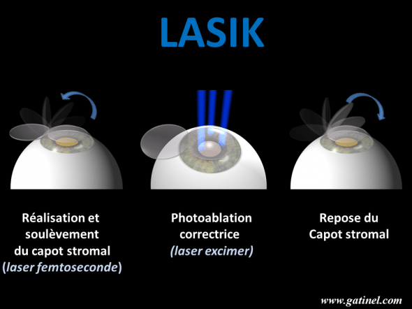 étapes du LASIK