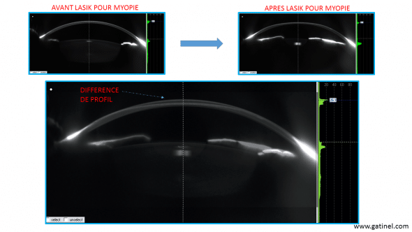 LASIK pour myopie forte