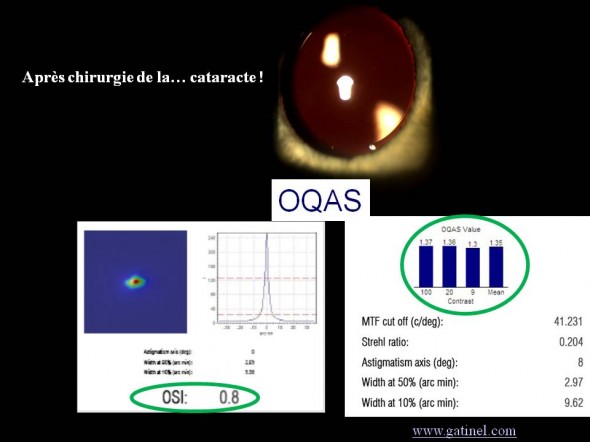 après chirurgie de la cataracte oqas OSI