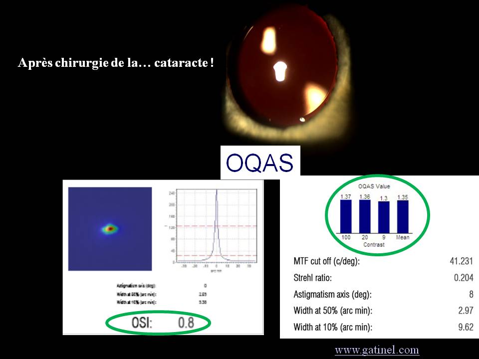 opération de la cataracte au laser