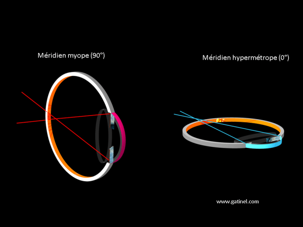 variations de vergence entre méridien vertical et horizontal oeil astigmate