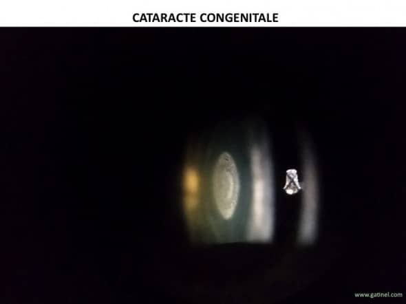 cataracte nucléaire