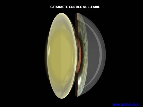 cataracte cortico nucleaire schema