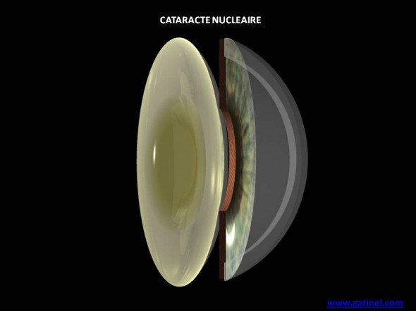 cataracte nucleaire schema