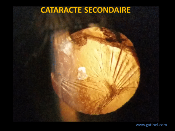 cataracte secondaire