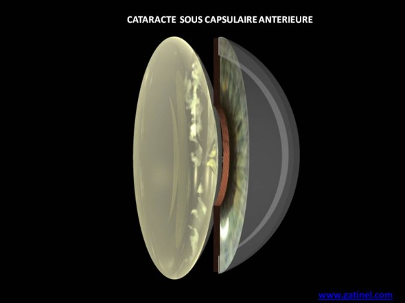 cataracte sous capsulaire antérieure schéma
