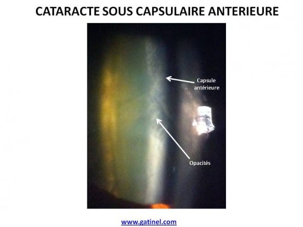 cataracte sous capsulaire antérieure photo