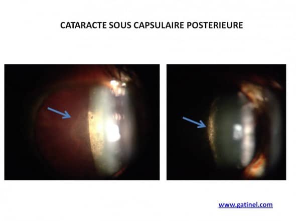 cataracte sous capsulaire postérieure 