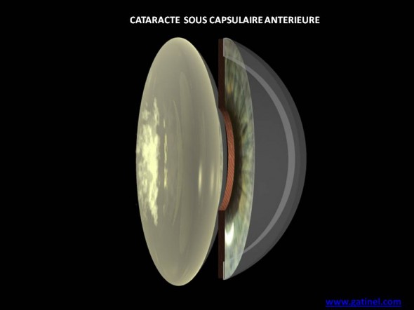 cataracte sous capsulaire posterieure schéma