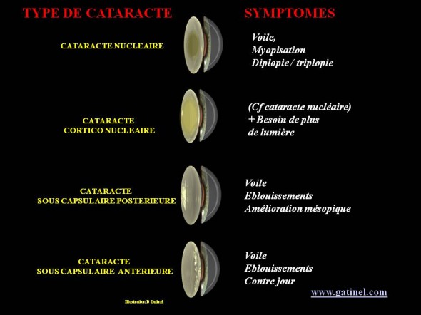 cataracte type symptomes associés anatomie cataracte