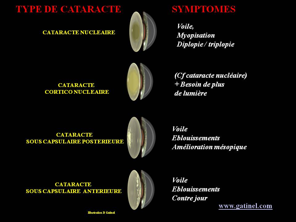La cataracte - Docteur Damien Gatinel