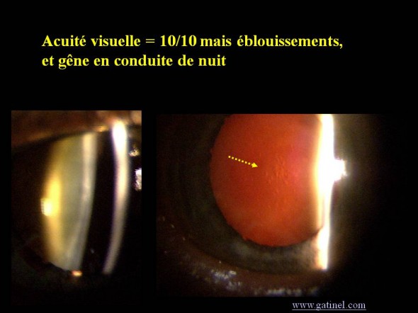 opalescence cristallinienne vacuoles cataracte