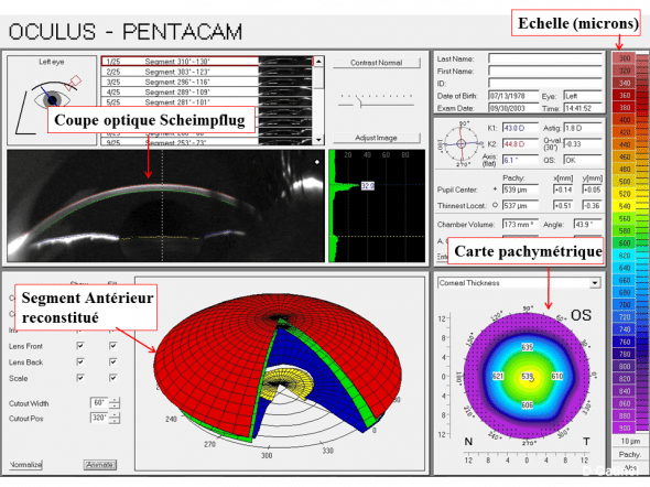 coupe scheimpflug topographe pentacam