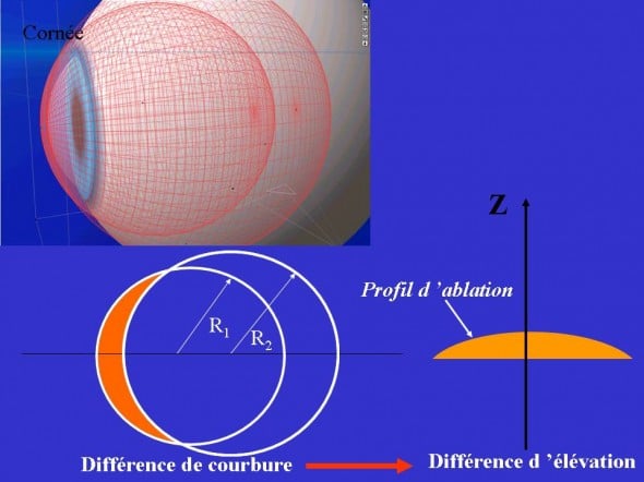 myopie correction profil d'ablation