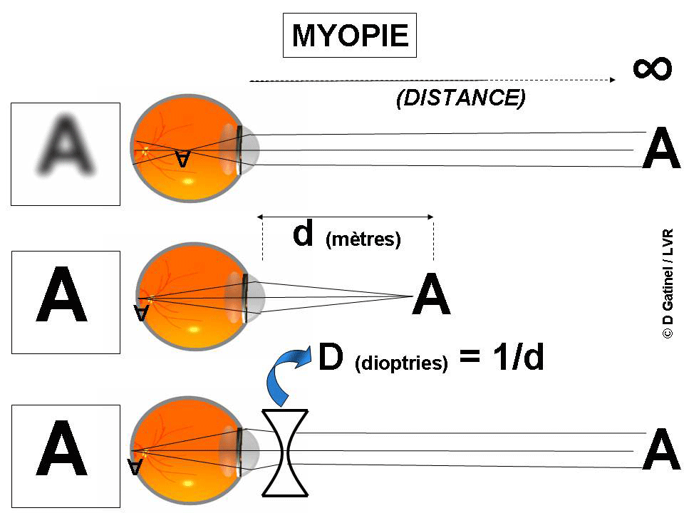 miopie dioptru 0 75