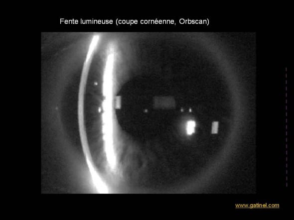 fente lumineuse cornée topographie d'élévation orbscan