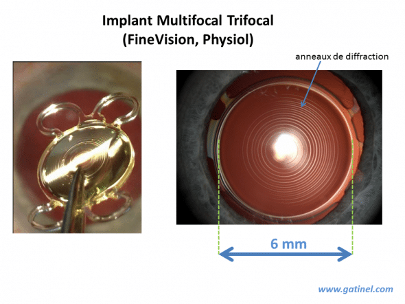 représentation de l'implant trifocal finevision en chirurgie de la cataracte