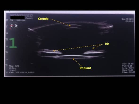 implant cristallin echographie haute frequence