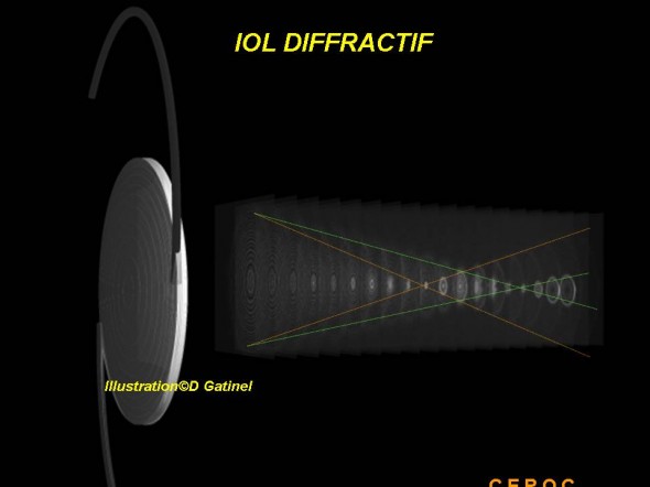 iol diffractif