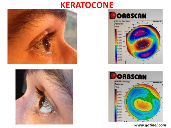 comparaison topographie d'élévation et profil en photo d'une cornée atteinte de kératocône