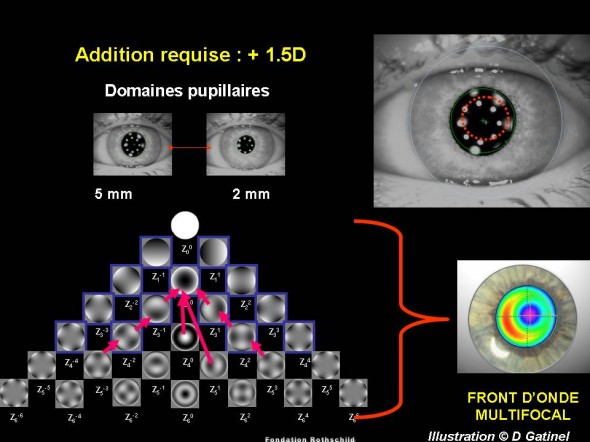 multifocalité aberrations de haut degré