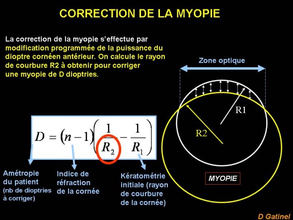 Myopie Profil