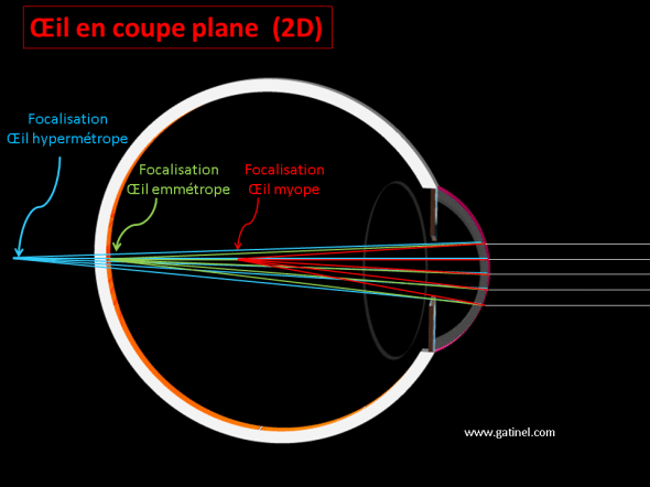 représentation des rayons dans un oeil myope hypermétrope ou astigmate en deux dimensions