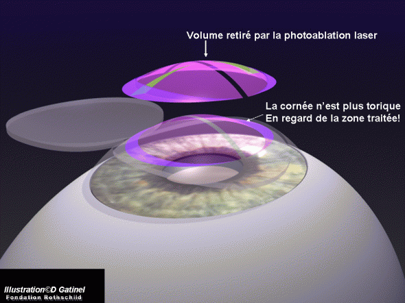 traitement cylindrique positif