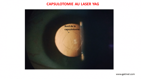 capsulotomie yag