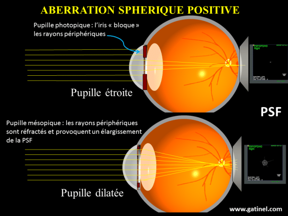 aberration sphérique positive et halos lumineux en conditions de dilatation pupillaire