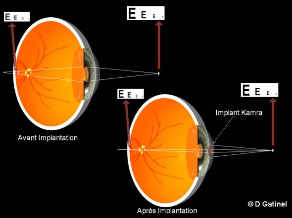 effet implant Kamra sur profondeur de champ