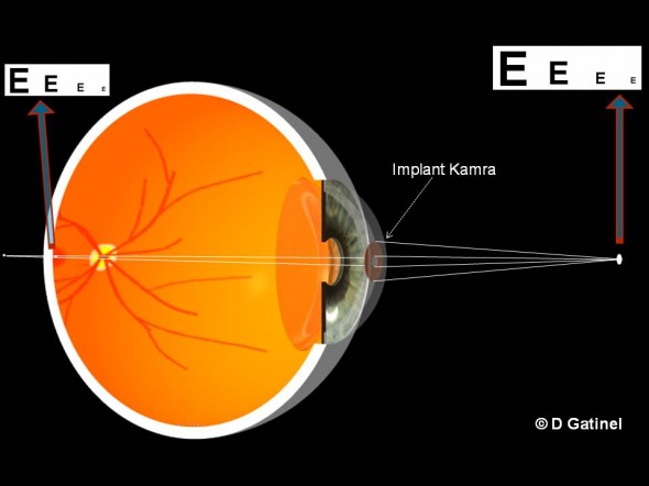 Implant Kamra inséré