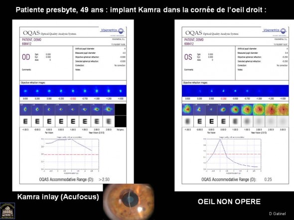 OQAS implant KAMRA