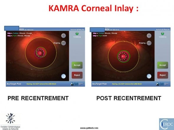 KAMRA inlay recentrement