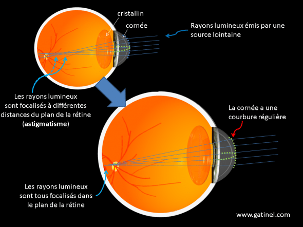 principes de la chirurgie de l'astigmatisme sur la cornée au laser excimer